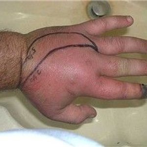 Swollen hand after Malaysian Hagen's Viper bit to the left index finger tip..jpg