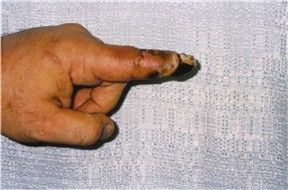 Hagen's Viper bite on left index finger4.jpg