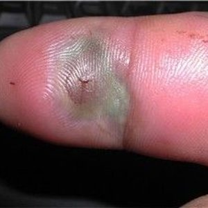 Egyptian Cobra bite to right index finger..jpg
