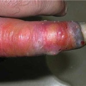 Hagen's Viper bite on left index finger2.jpg