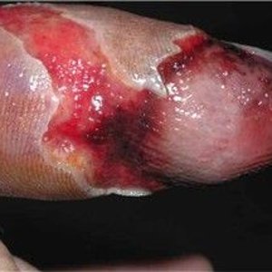 Hagen's Viper bite on left index finger3.jpg