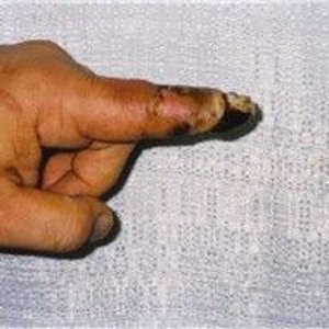 Hagen's Viper bite on left index finger4.jpg