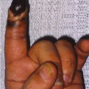 Hagen's Viper bite on left index finger5.jpg