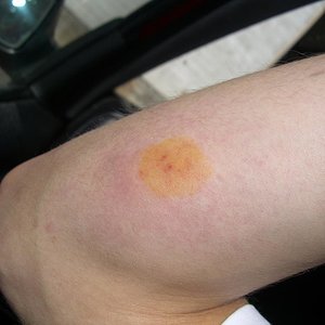 mordedura de haani1.JPG