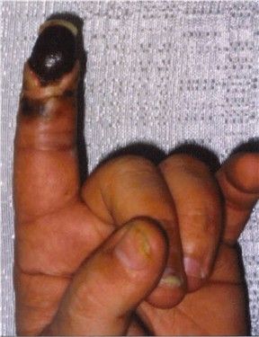 Hagen's Viper bite on left index finger5.jpg
